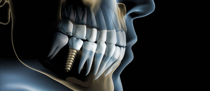 Implantate, Implantologie - Zahnarzt Praxis Papczyk in Gera